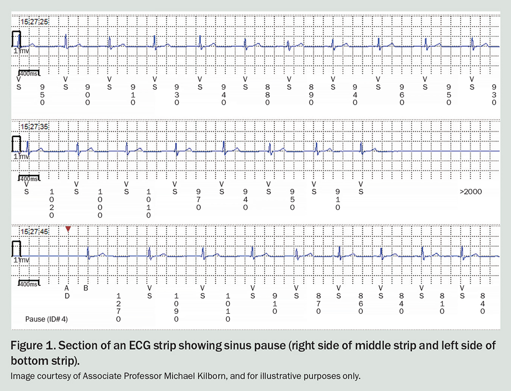 Sinus pause and arrest Cardiology Today